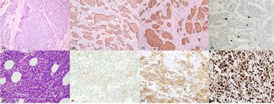 Pathology Reporting in Neuroendocrine Neoplasms of the Digestive System: Everything You Always Wanted to Know but Were Too Afraid to Ask